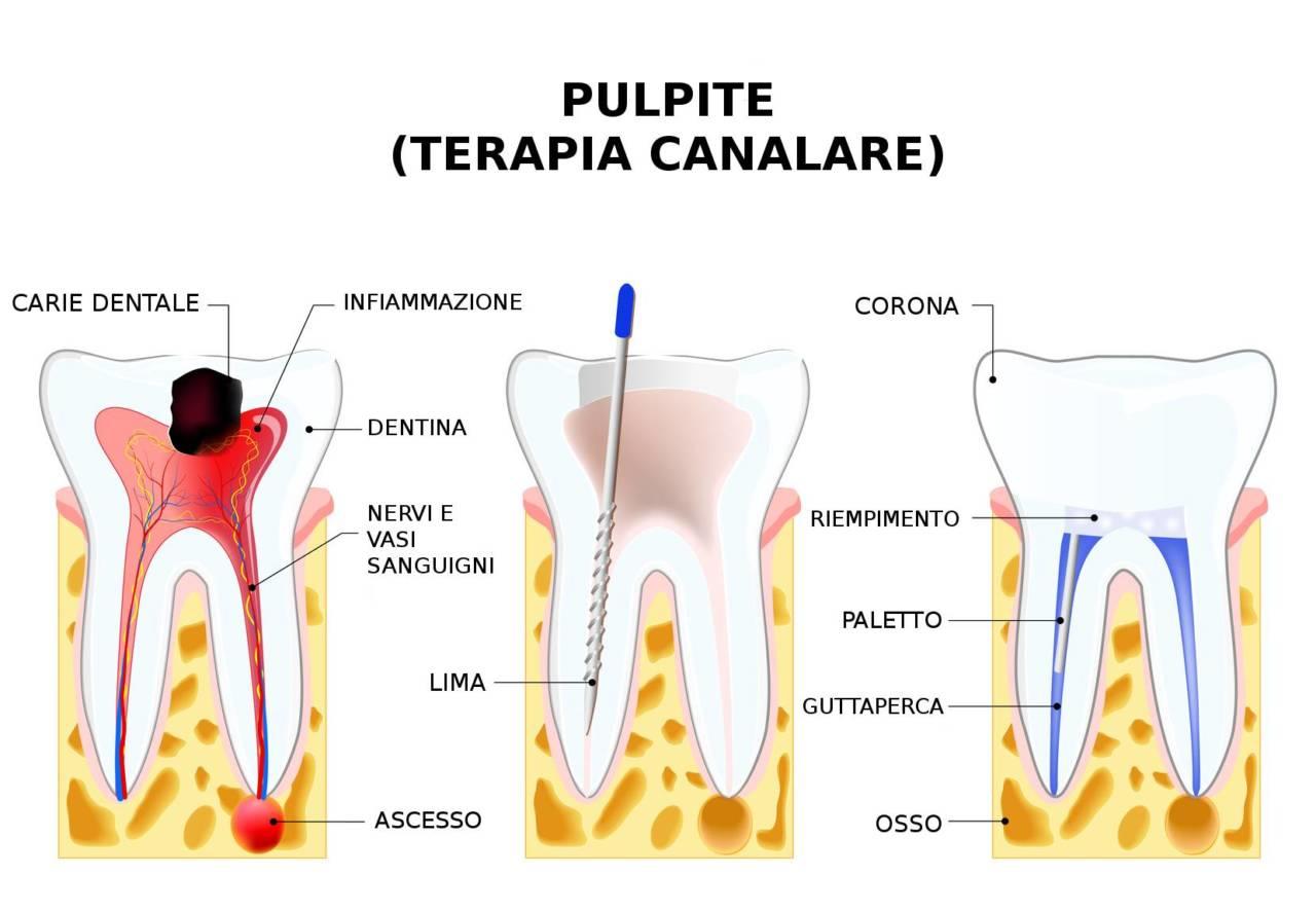 Endodonzia