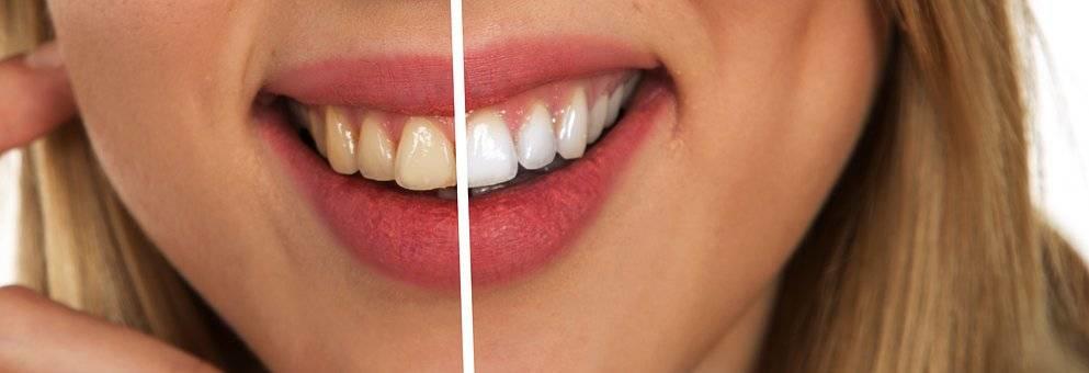 Seduta di igiene dentale 5 Seduta di igiene dentale 5