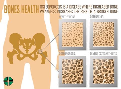 Osteoporosi