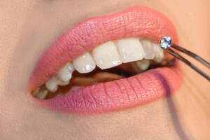 Dentist,Doctor,Select,A,Gem,Or,Rhinestone,For,The,Patient’s