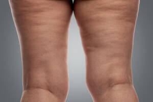 Women's,Legs,With,A,Problem,Of,Excess,Weight,And,Cellulite.