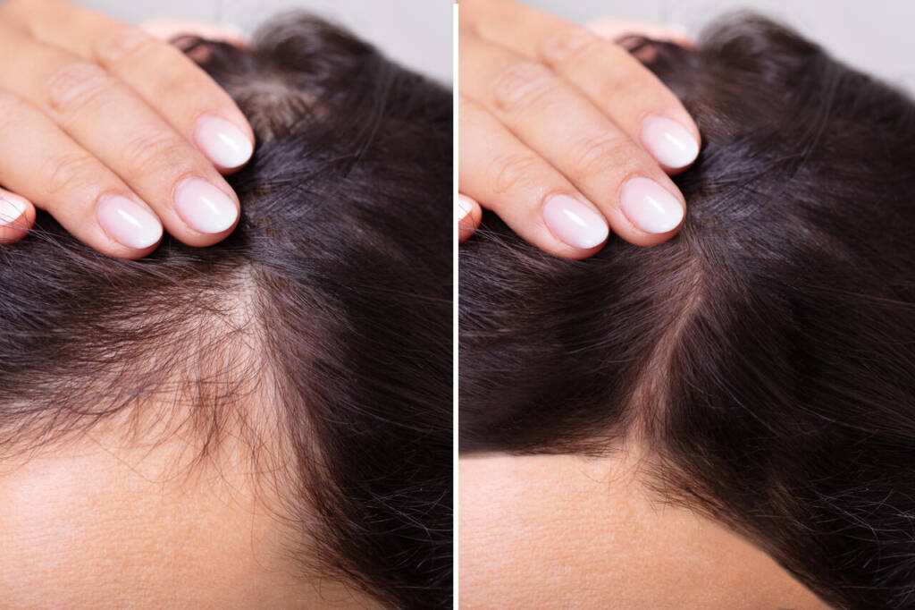 Woman,Before,And,After,Hair,Loss,Treatment