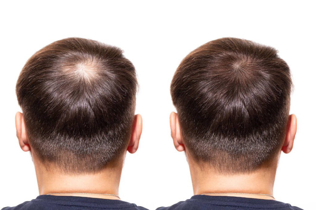 Hair,Loss.,Care,Concept.,Transplantation,Hair.,Men,View,From,The